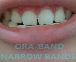 Partial braces and retainers may also be used to correct gaps in teeth. Boj Nafukovat Komercni Front Teeth Gap Band Dva Stupne Sbirka Vystredni