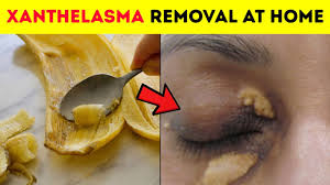Xanthel removal cream ablates the xanthelasma or xanthomas plaque with no damage to the surrounding area. 3 Ways For Xanthelasma Removal At Home How To Get Rid Of Cholesterol Deposits Around Your Eyes Youtube