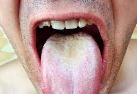 Some of these are completely harmless and easy to remedy, others are more at the same time though, you might find simply that you don't like the aesthetic appearance of a white tongue. Thrush The White Stuff Growing In Your Mouth And How To Get Rid Of It Health Essentials From Cleveland Clinic
