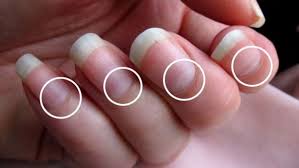 If You Do Not Have Half Moon Shape On Your Nails Immediately Visit A Doctor Nail Health Signs Fingernail Health Moons On Fingernails