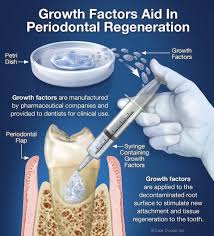 Periodontal Flap Surgery Inside The Periodontal Flap Periodontitis Periodontal Disease Treatment Gum Disease Treatment