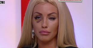 Loredana a decis să apeleze la medic pentru a își schimba silicoanele, cu care a. Loredana Chivu BÄƒtutÄƒ Cu Bestialitate In Scara Blocului E DesfiguratÄƒ Din Cauza Loviturilor
