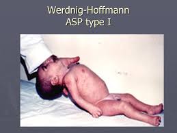 La maladie de charcot est familiale dans 10. Sclerose Laterale Amyotrophique Ou Maladie De Charcot Ppt Video Online Telecharger