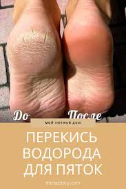 можно ли есть орехи при сахарном диабете 2 типа Perekis Vodoroda Dlya Pyatok Health Fitness Health And Fitness Tips Health Fitness Inspiration