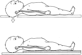 Image result for Pediatric Trauma Score