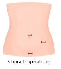Retrouvez la dernière actualité de la rédaction, des conseils, des fiches pratiques, des tests. Chirurgie De L Appendice A Montpellier Chirurgie Digestive