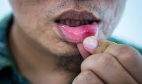 The stage of mouth cancer tells you its size and depth, and whether it has spread. Understanding Mouth Cancer