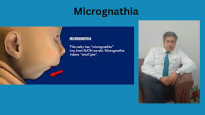 Image result for Micrognathia