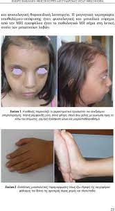 Maybe you would like to learn more about one of these? Enwris Emfanish Hbhs Se Koritsi Me Syndromo Wolf Hirschhorn Pdf Dwrean Lhpsh