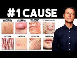 Image result for Contact Dermatitis
