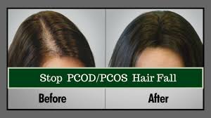 Weight gain is also a problem for some women, and tends to involve accumulation of excess fat in the abdomen. How To Stop Hair Fall Naturally How To Stop Hair Loss Hair Care Routine For Pcos Pcod Youtube