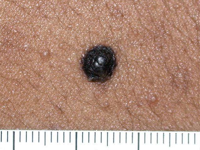 Is Your Mole a Cause for Concern?
