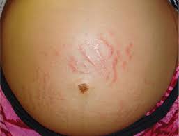 Image result for pruritic urticarial papules and plaques of pregnancy