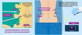 Image result for Radiofrequency Surgery