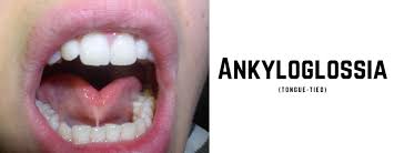 Image result for Ankyloglossia