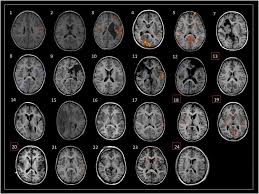 A real man has descended! Utility Of Mri Pet And Ictal Spect In Presurgical Evaluation Of Non Lesional Pediatric Epilepsy Seizure European Journal Of Epilepsy