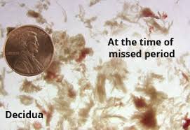 It is usually a sign of a miscarriage. Early Termination Of Pregnancy Find Private Abortion Services Medical Information On Early Abortion And Miscarriage With Mva And The Abortion Pill