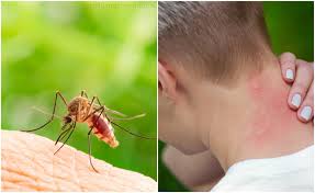 Skeeter syndrome (papular urticaria) is a localized allergic reaction to mosquito bites, consisting of inflammation and sometimes fever. Why Do My Mosquito Bites Sting And Swell Crafty Morning