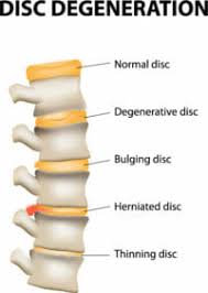 The worst and best sleep positions to reduce lower back pain, and how to fall asleep when your back hurts. Bulging Disc Symptoms Causes And Treatments Options