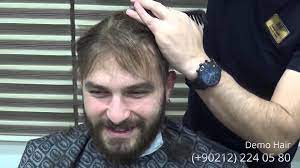 protez sac uygulamasi demo hair sac