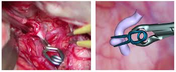 Real Time Surgery Simulation Of Intracranial Aneurysm Clipping With Patient Specific Geometries And Haptic Feedback An aneurysm is a bulge in the wall of a blood vessel caused by the weakening of the vessel wall.