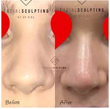 The Non Surgical Nose Job Facial Sculpting