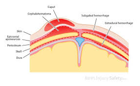Image result for Vacuum Caput