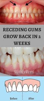 It is important to keep up with your daily home care routine, ie flossing, proxabrushes, waterpik, electric toothbrush, etc to help with healing and keep your gums healthy. 16 Teeth Ideas In 2021 Teeth Teeth Care Teeth Health