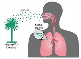 Aspergillosis fungal infections can occur in the ear canal, eyes, nose, sinus. Covid 19 Associated Pulmonary Aspergillosis Caused By Aspergillus Fumigatus