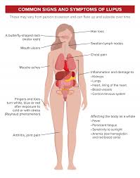 Lupus symptoms differ from person to person. Canadian Spondylitis Association Support Advocacy Lupus