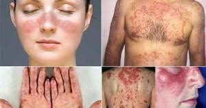 Manakala, selangor menjadi negara kedua penyumbang kes kusta iaitu di daerah petaling dan gombak. Doktor Wannabe Penyakit Kusta Hansen S Disease