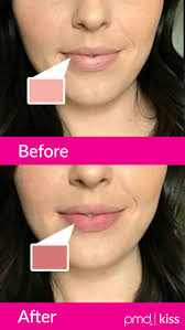 Anti Aging Lip Plumper Safe Lip Plumper Tool Pmd Kiss Pmd Beauty Anti Aging Lips Natural Lip Colors Lip Plumper