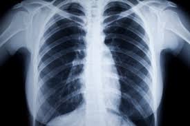 Image result for Acute Bronchitis