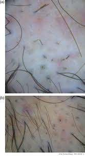 And just for general knowledge, if a person were to lose a hair with the follicle attached at any point after a hair transplant surgery (even if it was pulled out by accident etc.), what would this look like (or. Dermoscopy Of Early Dissecting Cellulitis Of The Scalp Simulates Alopecia Areata Actas Dermo Sifiliograficas English Edition