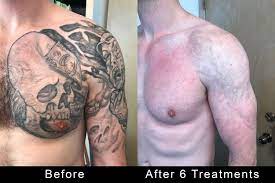 Up to 94% off laser hair removal at laseraway. Tattoo Removal Los Angeles Tattooremovers Ink