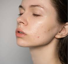 Acne Treatment in Phoenix, AZ | Regency Specialties