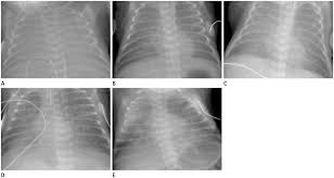 In respiratory distress syndrome (rds), the classic chest radiographic findings consist of pronounced hypoaeration, bilateral fine granular opacities in the pulmonary parenchyma, and peripherally hence, many neonatal units give antibiotics to all neonates with this condition until blood cultures are negative. Interpretation Of Neonatal Chest Radiography