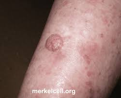 Image result for Merkel Cell Carcinoma