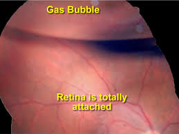 Your ophthalmologist will put drops in your eye to dilate (widen) a laser is used to seal the retina to the wall of the eye. Retinal Detachment Repair