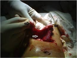 Persistent Mullerian Duct Syndrome A 24 Year Experience Journal Of Pediatric Surgery
