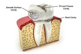 A filling is a common dental procedure that is often used to repair teeth that are chipped or decayed on one, two or three surfaces when damage is mild to. Smooth Surface Cavities My Dentist Burbank