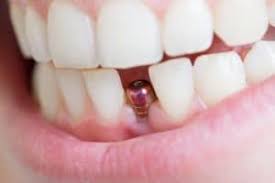 All dentalsave members save 25 percent on. 10 Ways To Get Low Cost Or Free Dental Implants Top Dentist Reviews