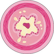 Emphysema is characterized by permanent enlargement of the bronchiole and. Ø¯Ø§Ø¡ Ø§Ù„Ø§Ù†Ø³Ø¯Ø§Ø¯ Ø§Ù„Ø±Ø¦ÙˆÙŠ Ø§Ù„Ù…Ø²Ù…Ù† Copd Ø£Ø³Ø¨Ø§Ø¨ Ø£Ø¹Ø±Ø§Ø¶ ØªØ´Ø®ÙŠØµ ÙˆØ¹Ù„Ø§Ø¬ Ø§Ù„Ø·Ø¨ÙŠØ¨