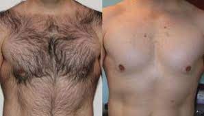 A host of bodybuilders use the hair removal product of a depilatory to remove all of their body hair. Laser Hair Removal Treatment Is Ideal For Bodybuilders