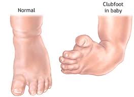 Image result for Clubfoot