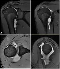 Hagl means have a good life. Posterior Shoulder Instability Due To Isolated Reverse Hagl Lesion In A Young Gymnast A Rare Mechanism Of Injury And Surgical Technique Sciencedirect