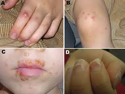 We did not find results for: Hand Foot And Mouth Disease What To Know About Virus That Disabled Yankees Mets Pitchers Nj Com