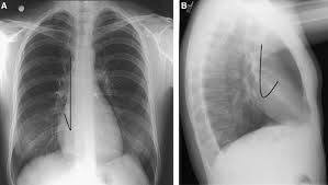 International normalized ratio (inr) is a measure of the extrinsic pathway of coagulation. Chest Radiographs Are Valuable In Demonstrating Clinically Significant Pacemaker Complications That Require Reoperation Sciencedirect
