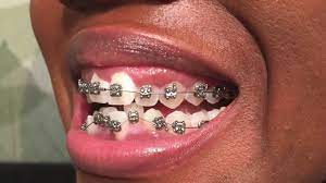 I had to learn how to chew with them. 2 I Got Braces Today Pics Eating Bite Block Pain Youtube