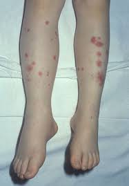 They may occur as a result of different health conditions, but especially a skin condition known as purpura. Purpuric And Petechial Rashes In Adults And Children Initial Assessment The Bmj